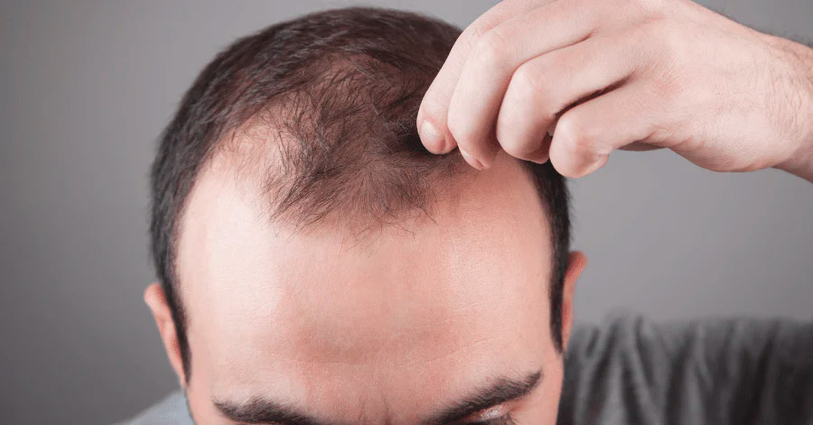 Кому лучше всего подходит PP405 для лечения алопеции: пол, возраст, генетика - Фото 3